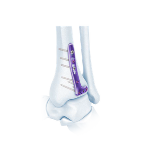 VA Distal Tibia Locking L-Plate
