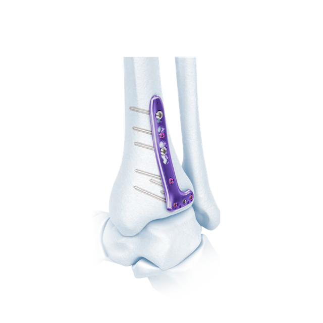 VA Distal Tibia Locking L-Plate