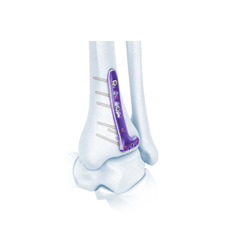 VA Distal Tibia Locking L-Plate
