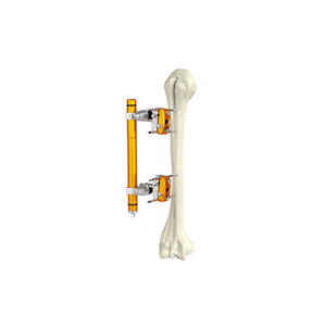 Humerus External Fixator