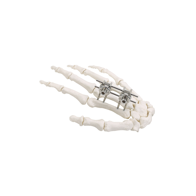 Mini- External Fixator(Finger & Palm)
