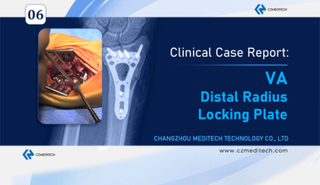 Distal Radius Fracture Surgery in Mexico — Using CZMEDITECH VA Locking Plate System (2).jpg
