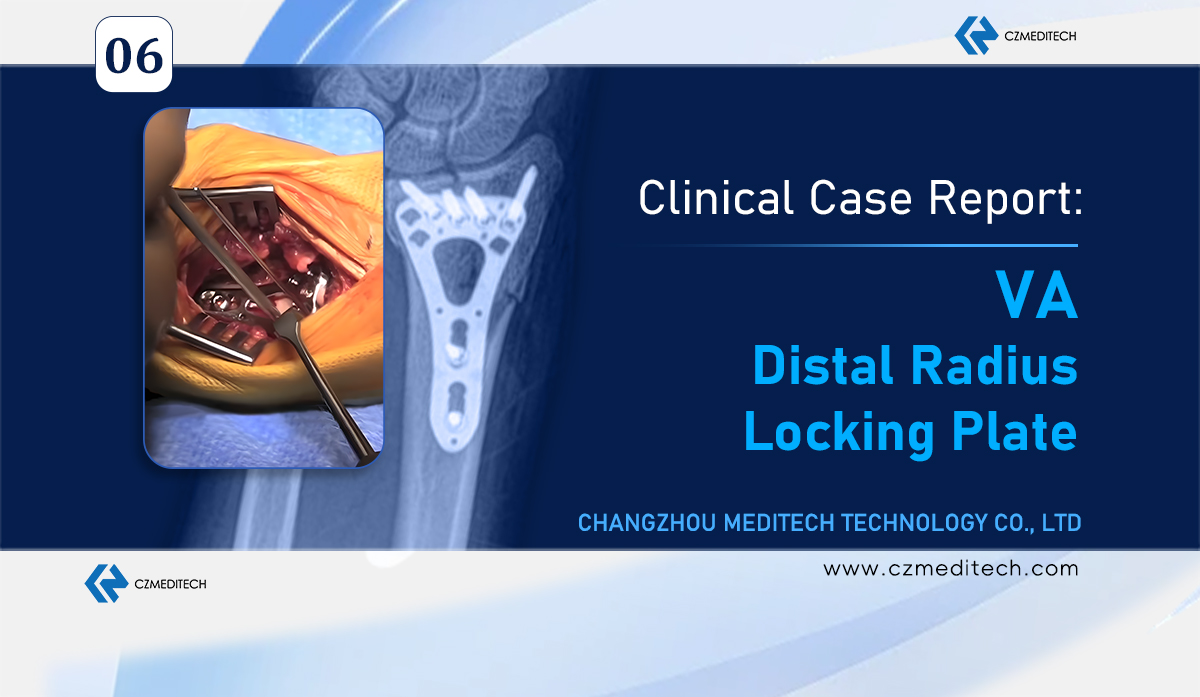 Successful Distal Radius Fracture Surgery in Mexico — Using CZMEDITECH VA Locking Plate System