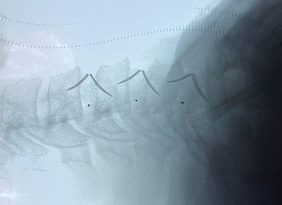 Postoperative X-ray showing stable fixation and alignment after Uni-C cervical cage implantation in Mexico 2