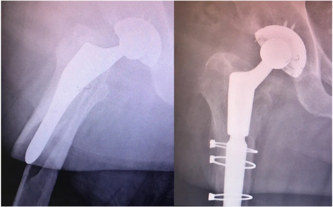 Arthroplasty and cerclage wire fixation for retrograde flap fractures.