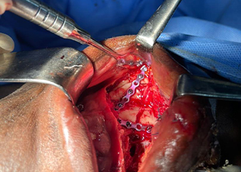 intraoperative-view-maxillofacial-plate-fixation-ghana2-czmeditech
