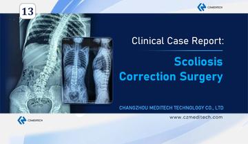 CZMEDITECH-Scoliosis-Correction-Surgery-Bangladesh-Teenage-Patient.jpg