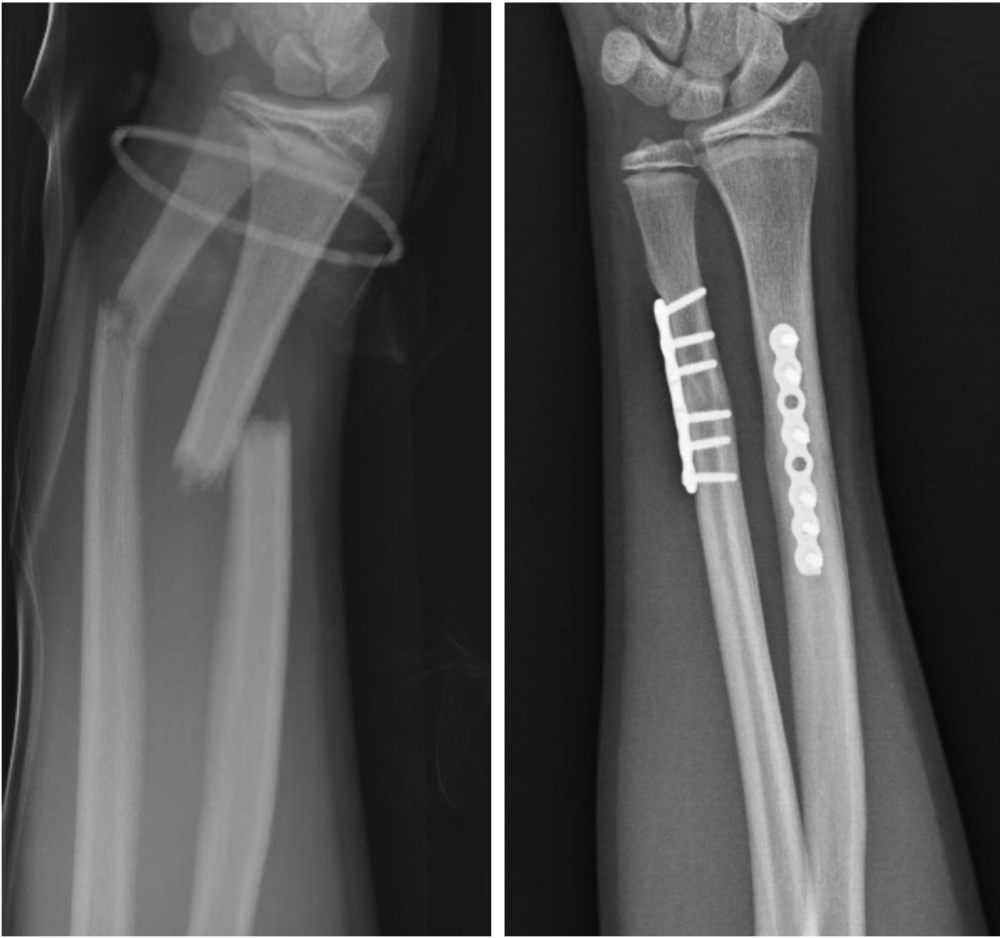 When do you need fracture surgery?