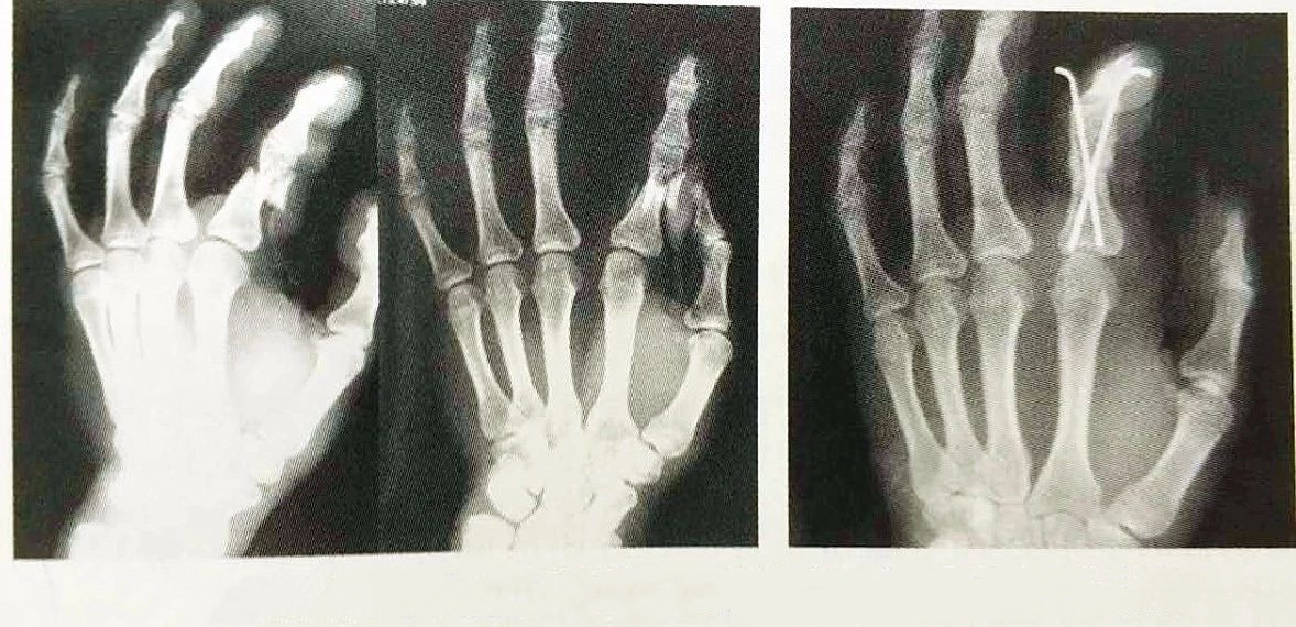 Klinikai tű