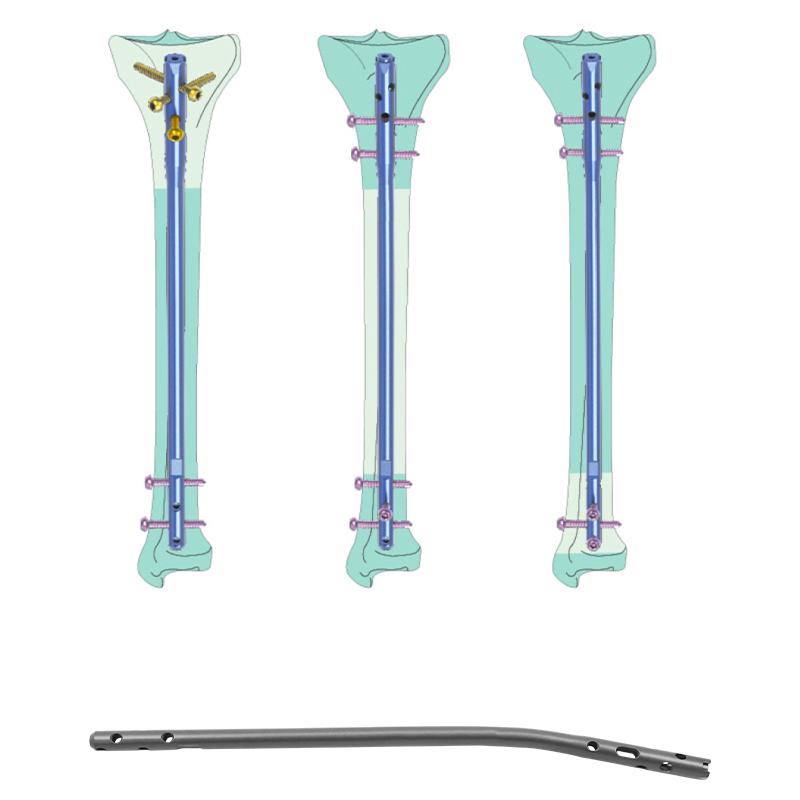 Expert-Tibia-Intramedullary-Nail