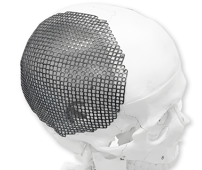 Titan mesh