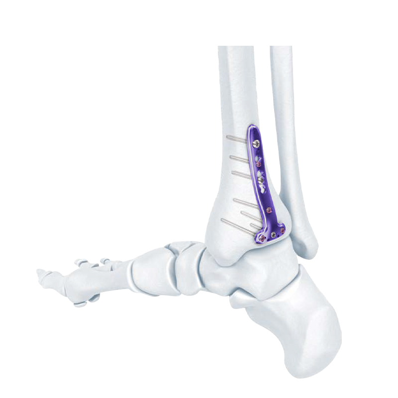 VA Distal Tibia Locking T-Plate