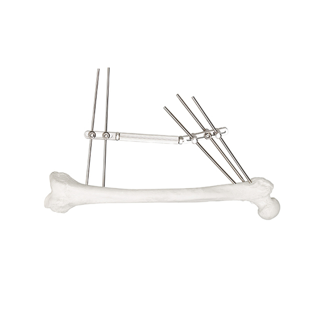 Dynamic External Fixator