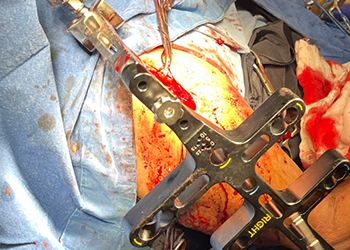 humeral-nail-insertion-procedure-czmeditech2