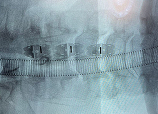 Postoperative X-ray showing stable fixation and alignment after Uni-C cervical cage implantation in Mexico 1