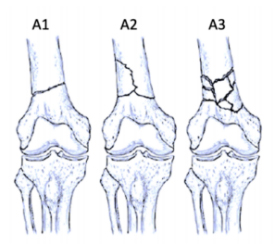 ao-classification-distal-femur-type-a