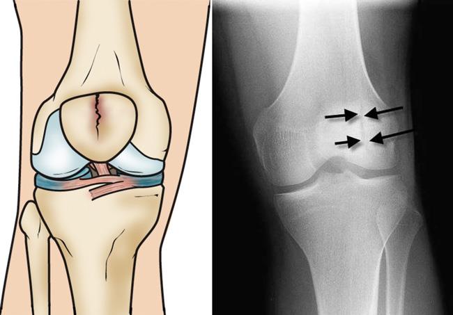 3 New Surgical Modalities to Address Patella Fractures