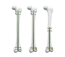 DFN Distal Femur Intramedullary Nail 
