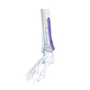 VA Distal Medial Tibia Locking Plate