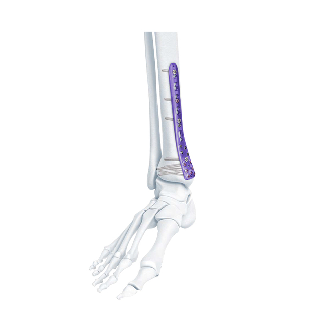 VA Distal Medial Tibia Locking Plate