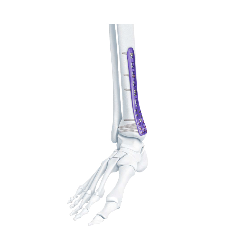 VA Distal Medial Tibia Locking Plate