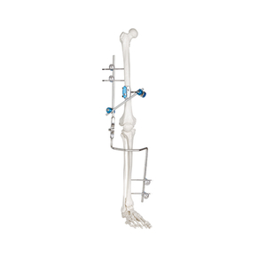 Knee Joint External Fixator