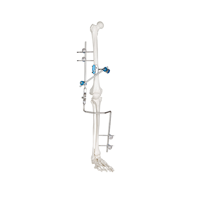 Knee Joint External Fixator