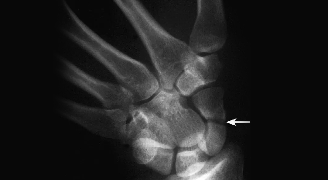Herbert Cannulated Compression Screw