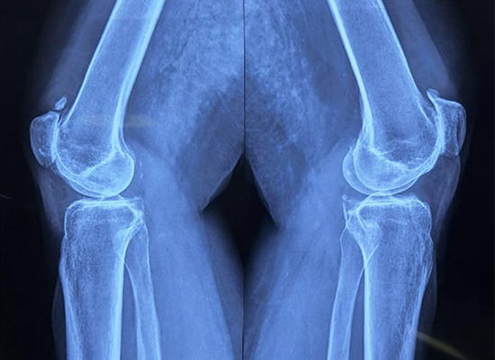 Knee Surface Replacement-czmeditech1