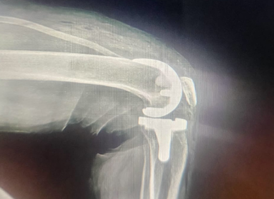 Knee Surface Replacement for Right Knee Deformity And Dysfunction-czmeditech5