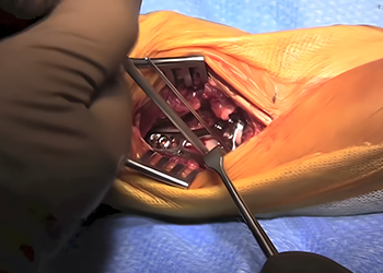 Distal Radius Fracture Surgery in Mexico &mdash; Using CZMEDITECH VA Locking Plate System3