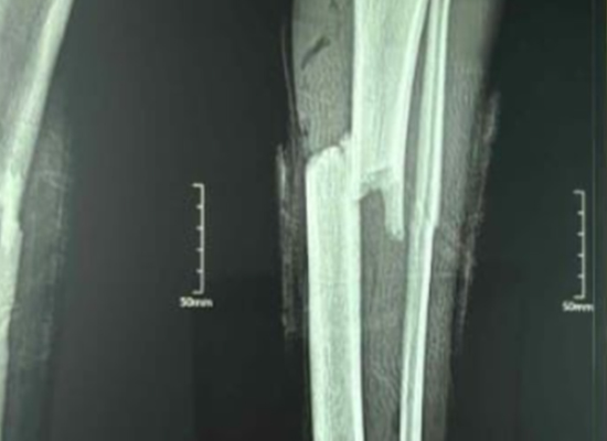 Preoperative X-ray of tibial fracture