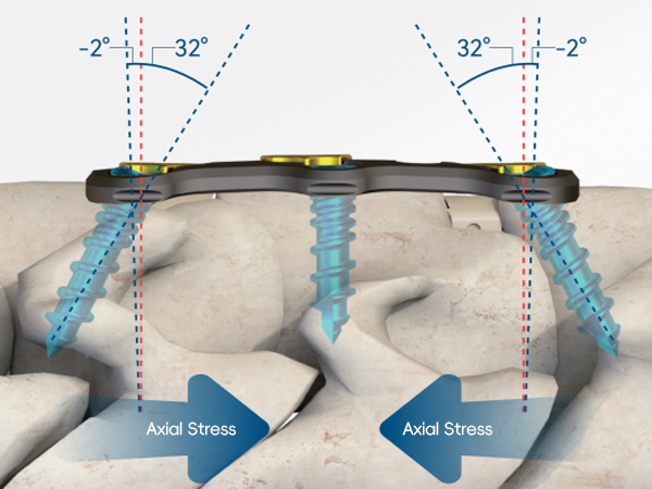 Anterior Cervical Corpectomy and Fusion (ACCF)-czmeditech6