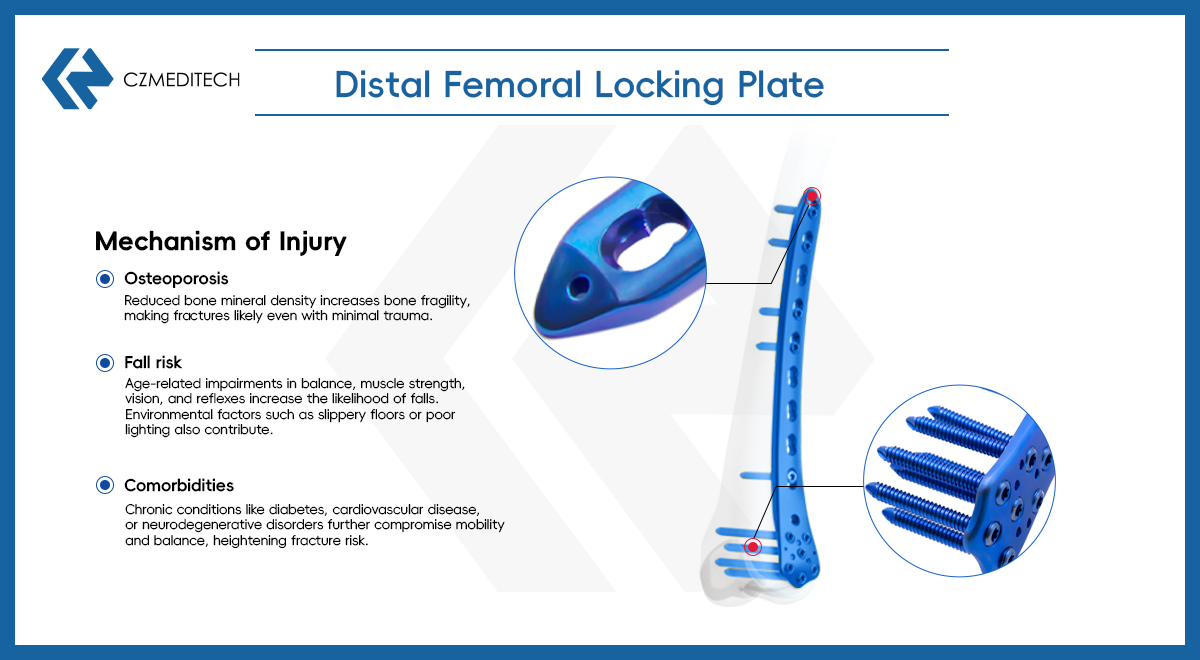 Classification And Treatment Techniques of Distal Femoral Fractures