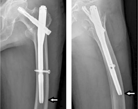 X-ray-shows-the-tip-of-the-PFNA-II-against-the-lateral-wall-in-elderly-patients-with-a_副本