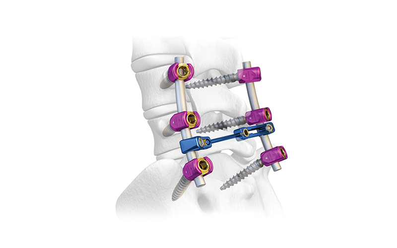 6.0-Spinal-Pedicle-Screw-System