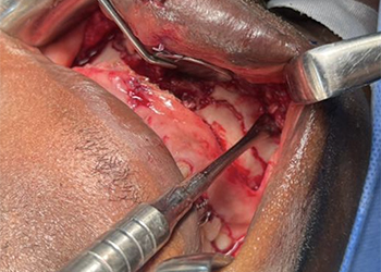 intraoperative-view-maxillofacial-plate-fixation-ghana1-czmeditech