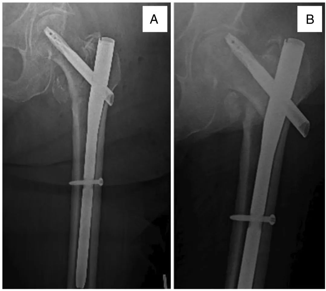 What if the internal fixation of an inter rotator fracture fails?