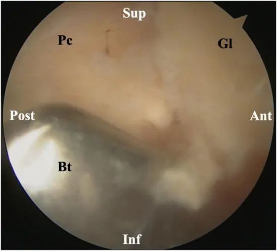 Arthroscopic treatment of posterior shoulder instability