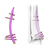 Distal Tibial Intramedullary Nail (DTN)