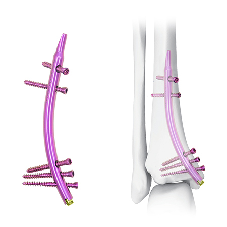 Distal Tibial Intramedullary Nail (DTN)