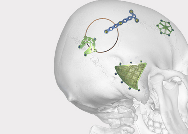 Neuro Plating System