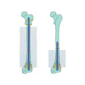 Expert Reversed Femoral Intertan Intramedullary Nail