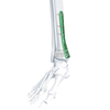 VA Distal Medial Tibia Locking Plate
