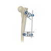 Proximal Femur External Fixator