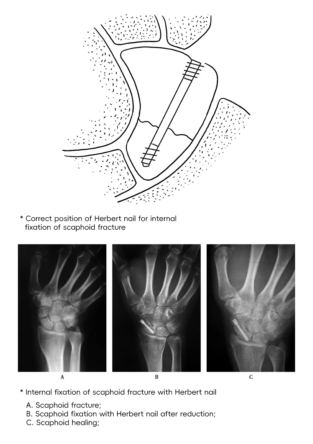 Herbert Cannulated Compression Screw