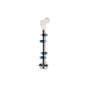 T Frame External Fixator