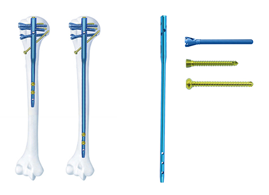 Multi-lock Humeral Intramedullary Nail-czmeditech