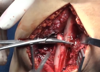 clavicle-surgery-orif-procedure-mexico-czmeditech