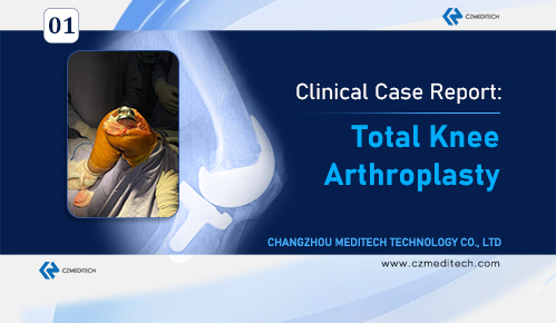Clinical Case: Knee Surface Replacement for Right Knee Deformity And Dysfunction